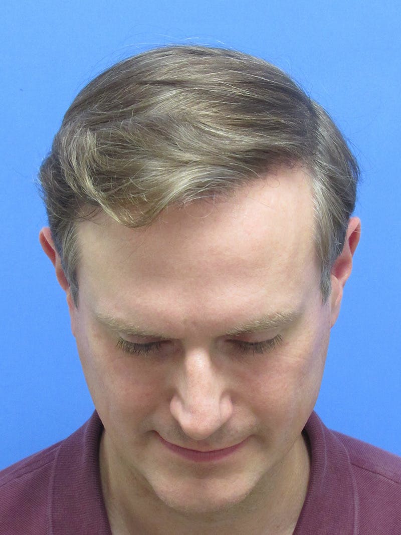 Male Hair Transplant Before & After Gallery - Patient 288585 - Image 2