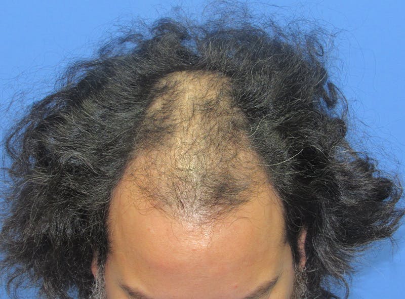Male Hair Transplant Before & After Gallery - Patient 282000 - Image 1