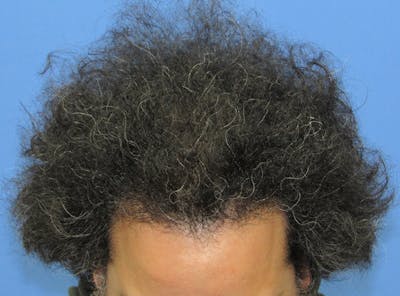 Male Hair Transplant Before & After Gallery - Patient 282000 - Image 2