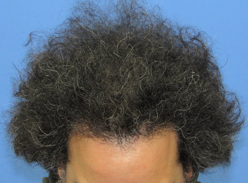 Male Hair Transplant Before & After Gallery - Patient 282000 - Image 2