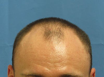 Male Hair Transplant Before & After Gallery - Patient 401249 - Image 1