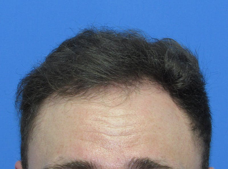 Male Hair Transplant Before & After Gallery - Patient 401249 - Image 2