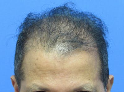 Male Hair Transplant Before & After Gallery - Patient 128488 - Image 1