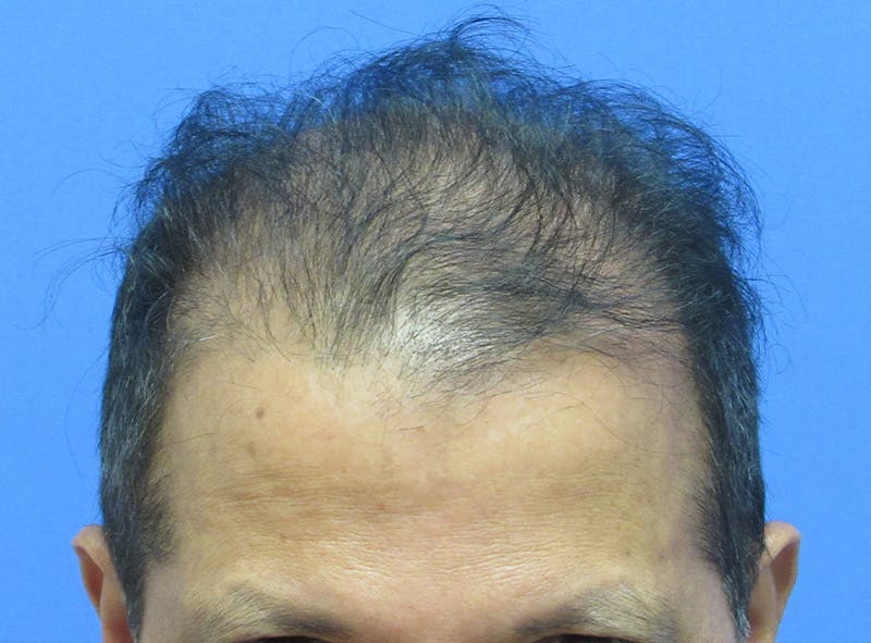 Male Hair Transplant Before & After Gallery - Patient 128488 - Image 1