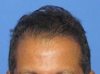 Male Hair Transplant Before & After Gallery - Patient 128488 - Image 2