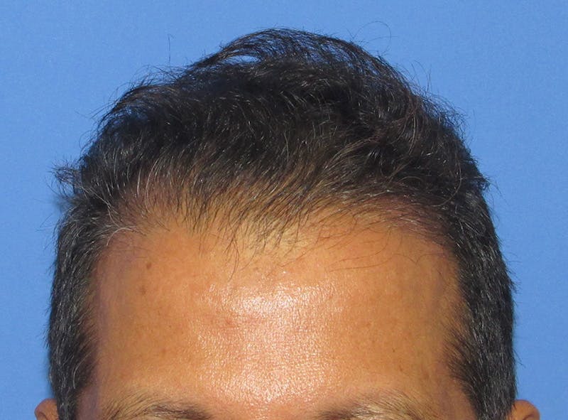 Male Hair Transplant Before & After Gallery - Patient 128488 - Image 2