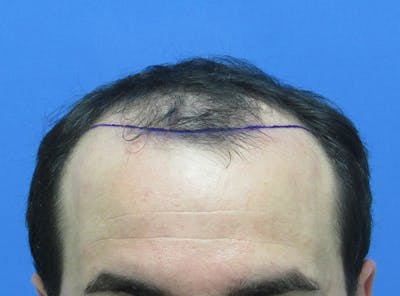 Male Hair Transplant Before & After Gallery - Patient 385090 - Image 1