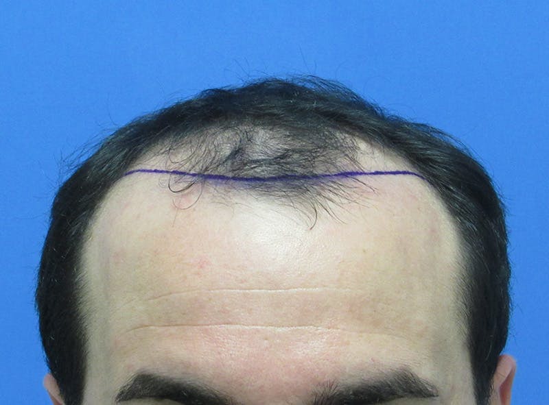 Male Hair Transplant Before & After Gallery - Patient 385090 - Image 1