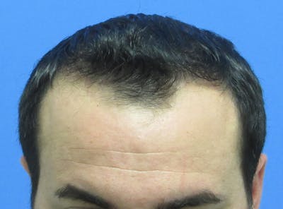 Male Hair Transplant Before & After Gallery - Patient 385090 - Image 2