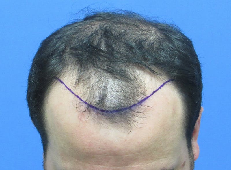 Male Hair Transplant Before & After Gallery - Patient 385090 - Image 3