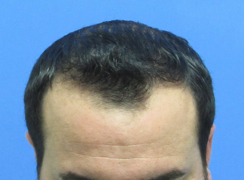 Male Hair Transplant Before & After Gallery - Patient 385090 - Image 4