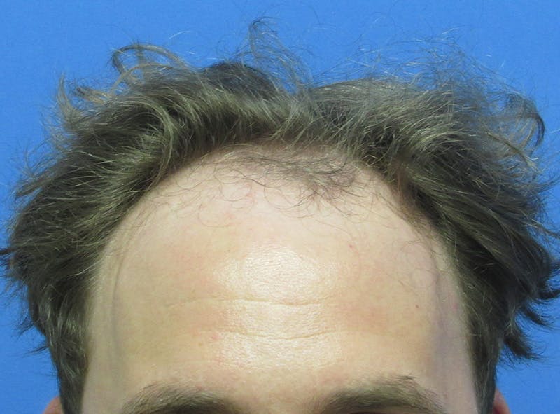 Male Hair Transplant Before & After Gallery - Patient 131869 - Image 1
