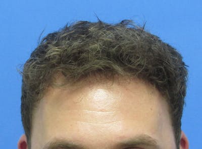 Male Hair Transplant Before & After Gallery - Patient 131869 - Image 2