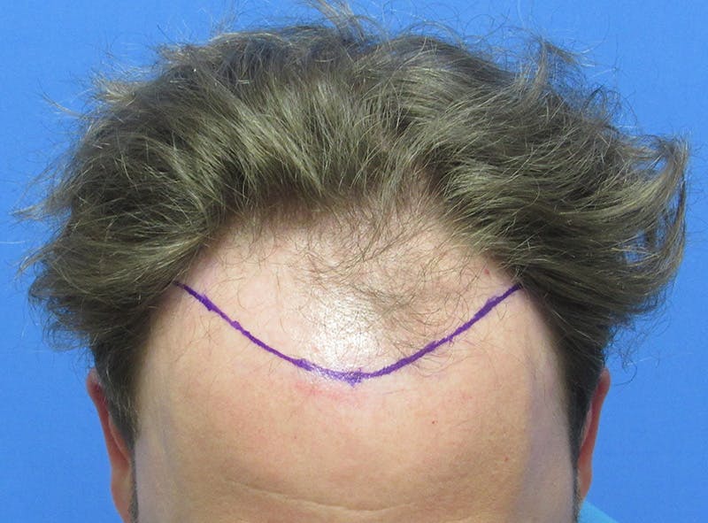 Male Hair Transplant Before & After Gallery - Patient 131869 - Image 3