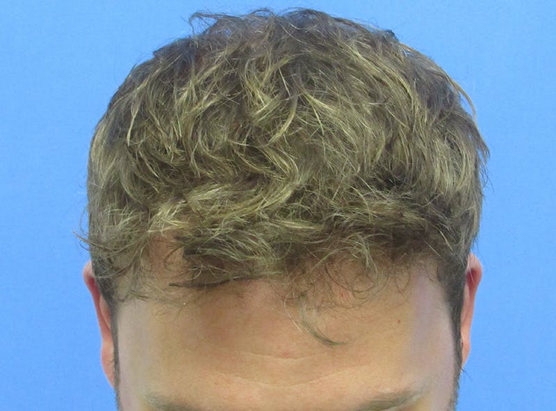 Male Hair Transplant Before & After Gallery - Patient 131869 - Image 4