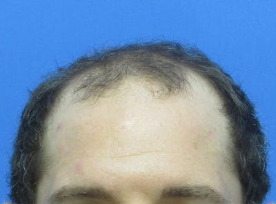 Male Hair Transplant Before & After Gallery - Patient 408286 - Image 1