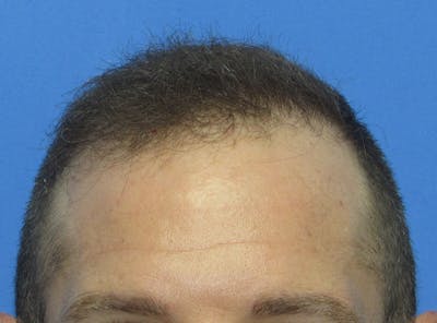 Male Hair Transplant Before & After Gallery - Patient 408286 - Image 2