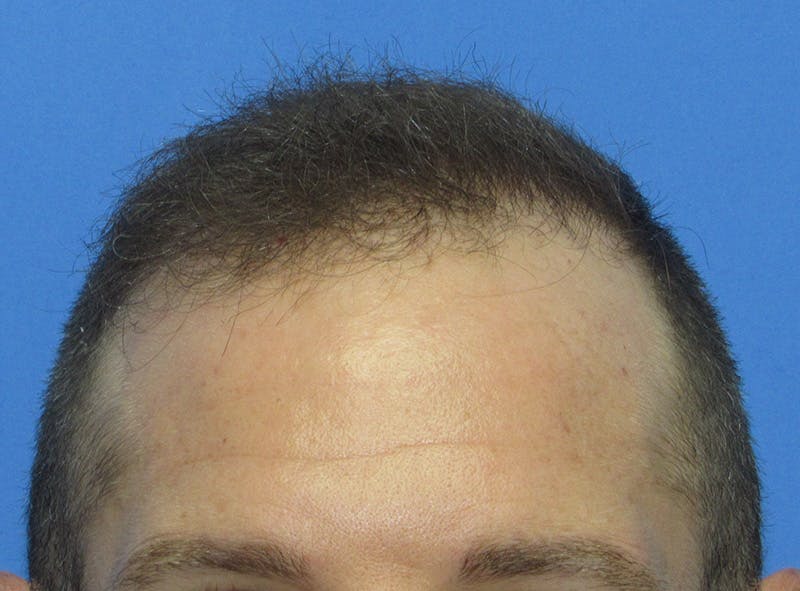 Male Hair Transplant Before & After Gallery - Patient 408286 - Image 2