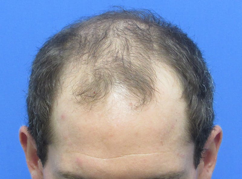 Male Hair Transplant Before & After Gallery - Patient 408286 - Image 3
