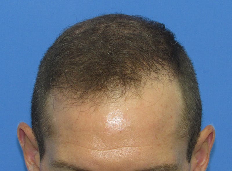 Male Hair Transplant Before & After Gallery - Patient 408286 - Image 4