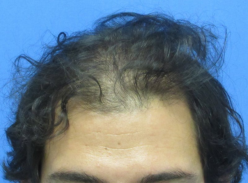 Male Hair Transplant Before & After Gallery - Patient 940027 - Image 1