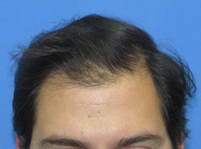 Male Hair Transplant Before & After Gallery - Patient 940027 - Image 2