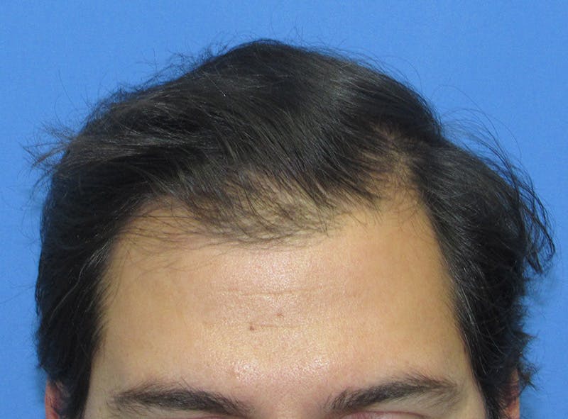 Male Hair Transplant Before & After Gallery - Patient 940027 - Image 2
