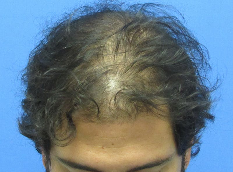 Male Hair Transplant Before & After Gallery - Patient 940027 - Image 3