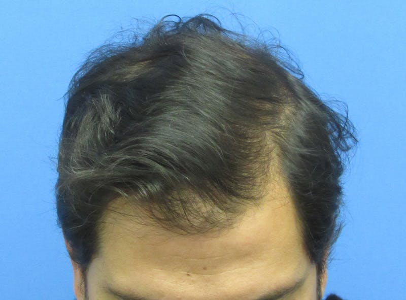 Male Hair Transplant Before & After Gallery - Patient 940027 - Image 4