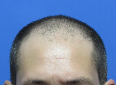 Male Hair Transplant Before & After Gallery - Patient 424990 - Image 1
