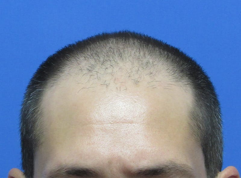 Male Hair Transplant Before & After Gallery - Patient 424990 - Image 1