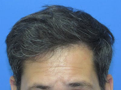 Male Hair Transplant Before & After Gallery - Patient 424990 - Image 2