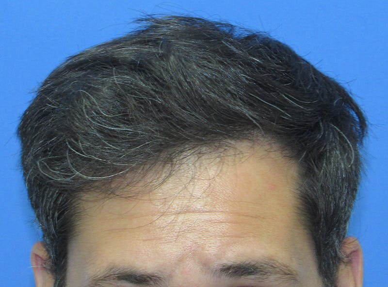 Male Hair Transplant Before & After Gallery - Patient 424990 - Image 2