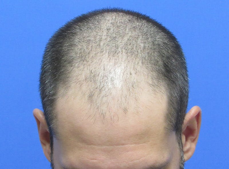 Male Hair Transplant Before & After Gallery - Patient 424990 - Image 3