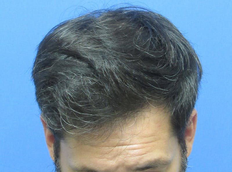 Male Hair Transplant Before & After Gallery - Patient 424990 - Image 4