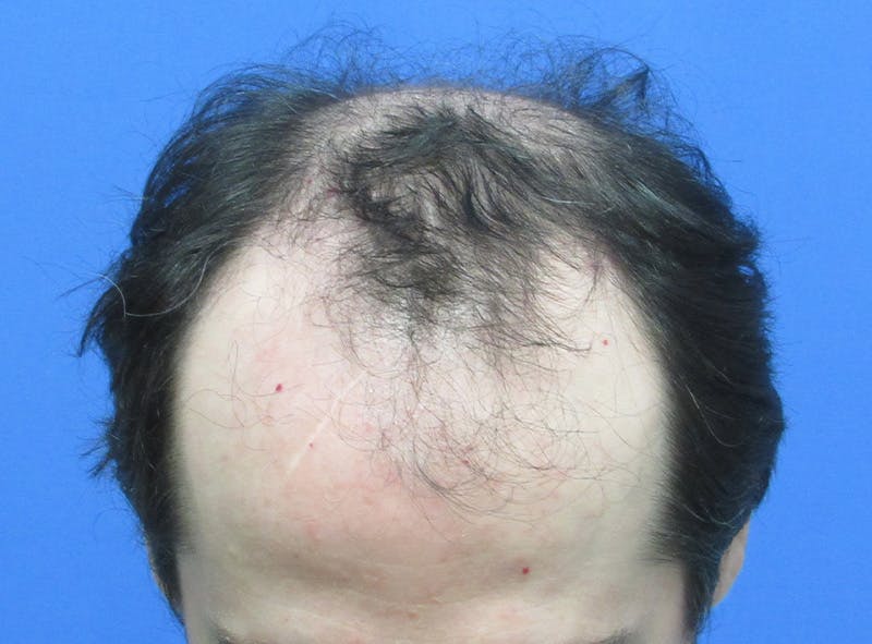 Male Hair Transplant Before & After Gallery - Patient 407490 - Image 1