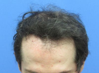 Male Hair Transplant Before & After Gallery - Patient 407490 - Image 2