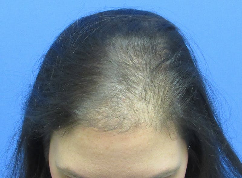 Female Hair Transplant Before & After Gallery - Patient 394139 - Image 1