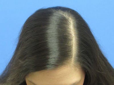 Female Hair Transplant Before & After Gallery - Patient 394139 - Image 2