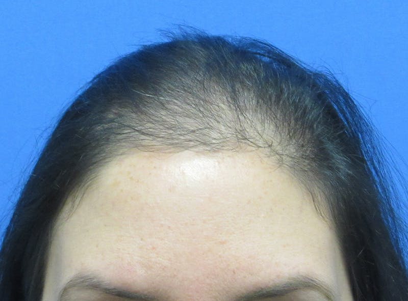 Female Hair Transplant Before & After Gallery - Patient 394139 - Image 3