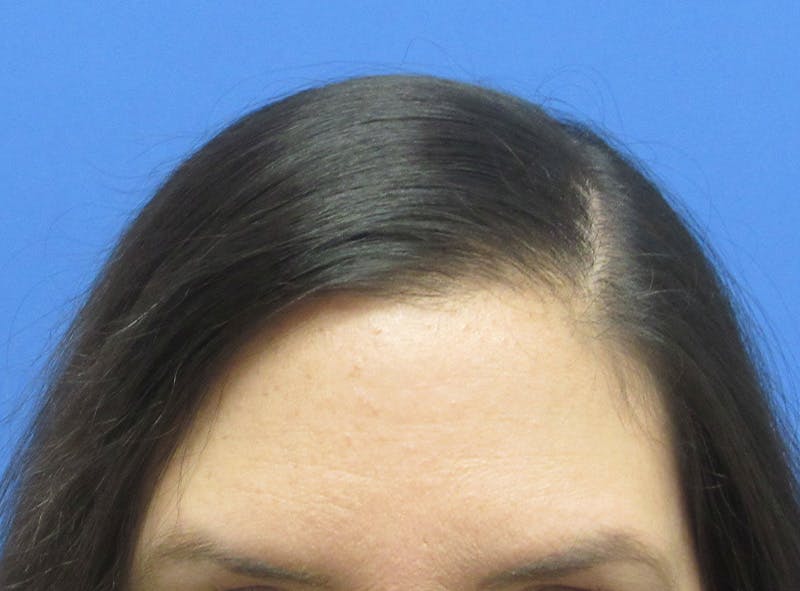 Female Hair Transplant Before & After Gallery - Patient 394139 - Image 4