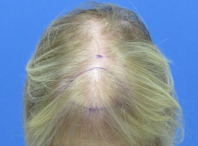 Female Hair Transplant Before & After Gallery - Patient 136308 - Image 1