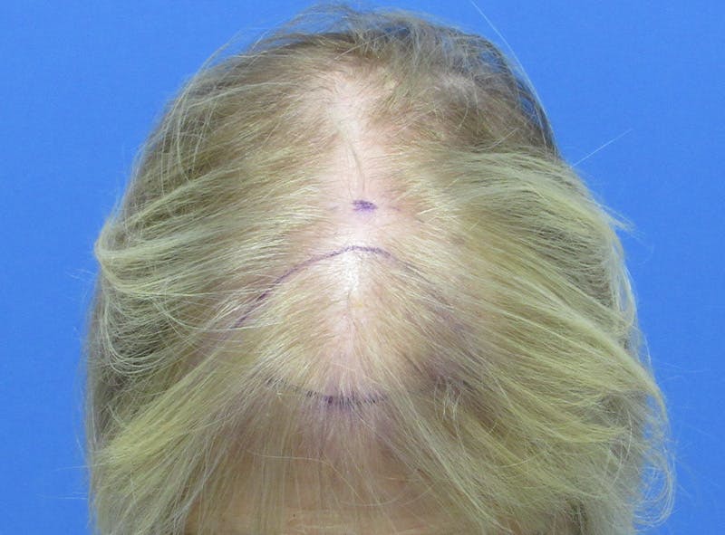 Female Hair Transplant Before & After Gallery - Patient 136308 - Image 1