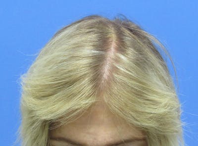 Female Hair Transplant Before & After Gallery - Patient 136308 - Image 2