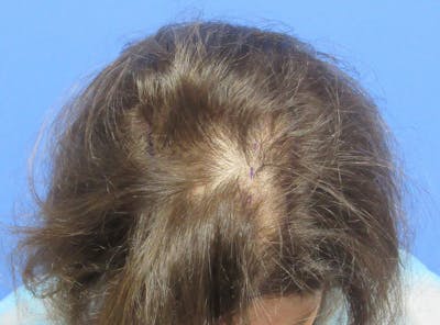 Female Hair Transplant Before & After Gallery - Patient 241019 - Image 1