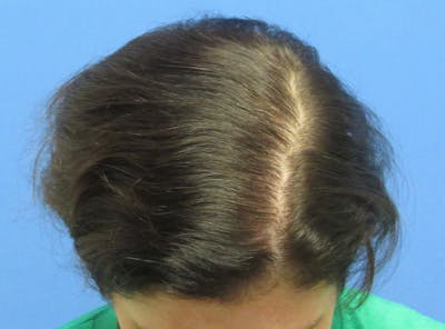 Female Hair Transplant Before & After Gallery - Patient 241019 - Image 2