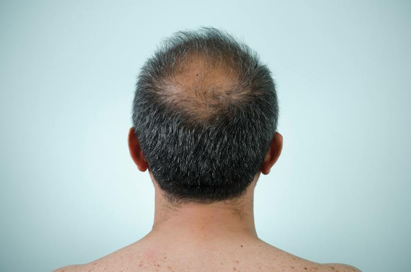 man with bald spot