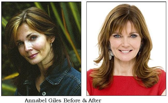 A facelift procedure performed by a board-certified surgeon will tighten your loose skin.