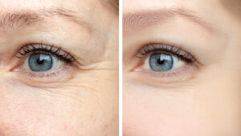 blepharoplasty results