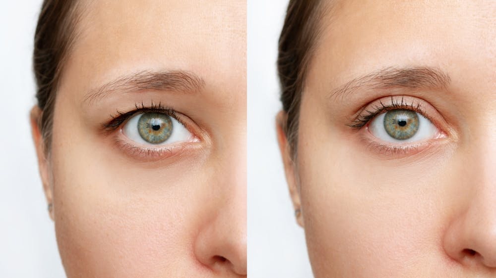 Dr. Mark and Robert Glasgold provide permanent solution removing extra skin from upper lid and smooths your eyes' appearance